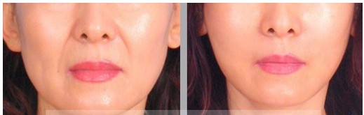 填充鼻唇沟,鼻唇沟价格,玻尿酸填充