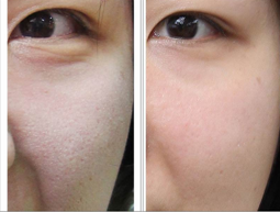 长春激光嫩肤,辉煌激光360,长春彩光嫩肤