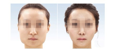 长春削骨瘦脸,瘦脸多少钱,长春瘦脸价格