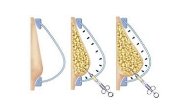 长春注射隆胸,注射隆胸效果,玻尿酸隆胸