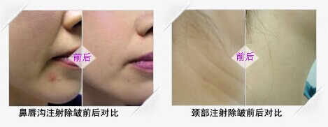 长春乔雅登,乔雅登去皱,乔雅登玻尿酸