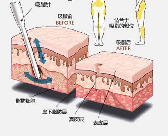 长春吸脂塑形,吸脂哪里好,铭医吸脂塑形