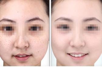 长春激光祛斑,铭医激光祛斑,激光祛斑价格