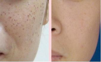 长春激光祛斑,铭医激光祛斑,激光祛斑价格