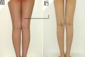 水动力吸脂,长春吸脂瘦腿,瘦腿哪里好