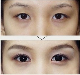 长春眼部整形,长春双眼皮,长春开眼角