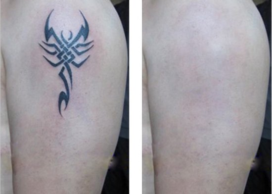 长春洗纹身,洗纹身哪里好,洗纹身价格