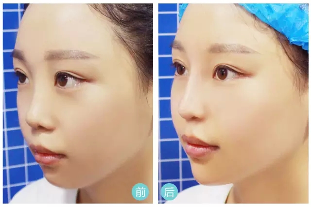 长春玻尿酸,玻尿酸隆鼻,隆鼻哪里好