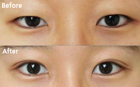 长春双眼皮,双眼皮图片,双眼皮哪里好