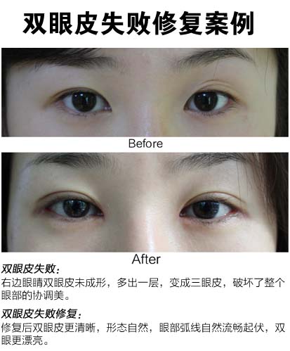 长春双眼皮,双眼皮修复,双眼皮哪里好
