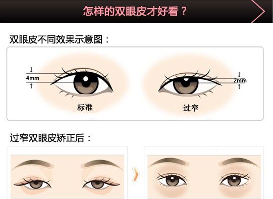 长春双眼皮,双眼皮修复,双眼皮哪里好