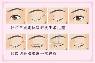长春双眼皮,双眼皮修复,双眼皮哪里好