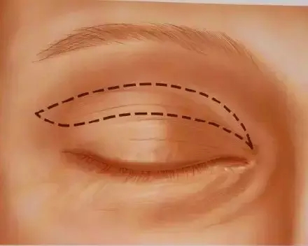 长春双眼皮,双眼皮设计