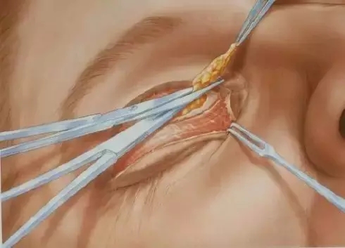 长春双眼皮,双眼皮设计