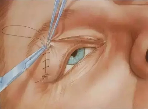 长春双眼皮,双眼皮设计