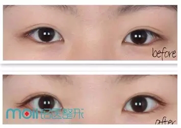 长春双眼皮,双眼皮设计