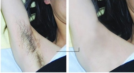 脱毛对比图