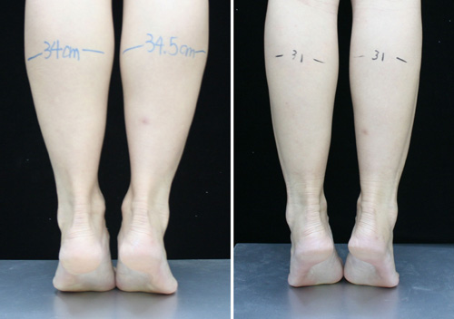 瘦腿对比图