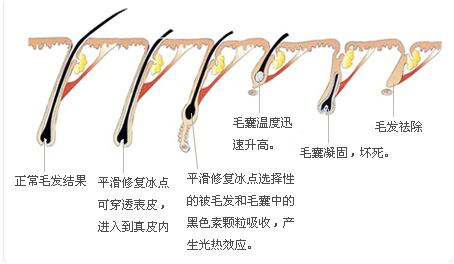长春铭医脱毛,长春脱毛