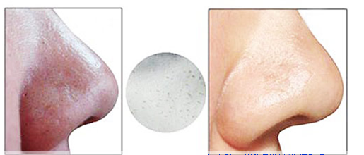 毛孔粗大对比图