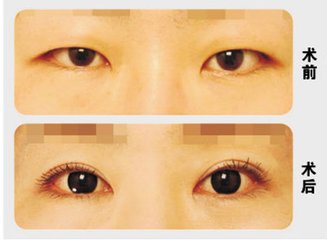 长春双眼皮