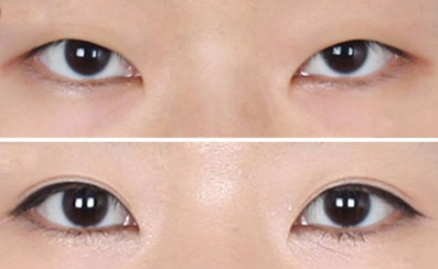 双眼皮对比图