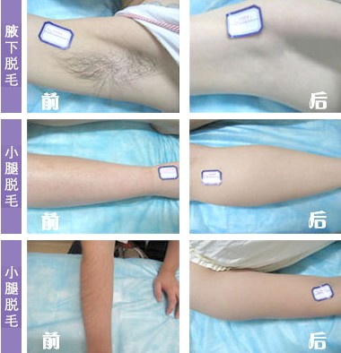 脱毛对比图