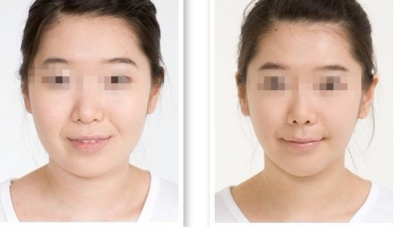 瘦脸对比图