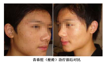 激光去痤疮对比图
