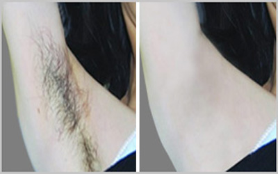 脱毛对比图