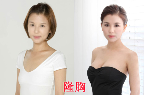 自体脂肪,隆胸,对比图,长春好的整形医院