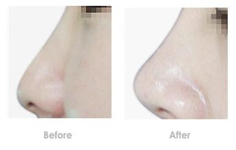 隆鼻,对比图,长春好的整形医院