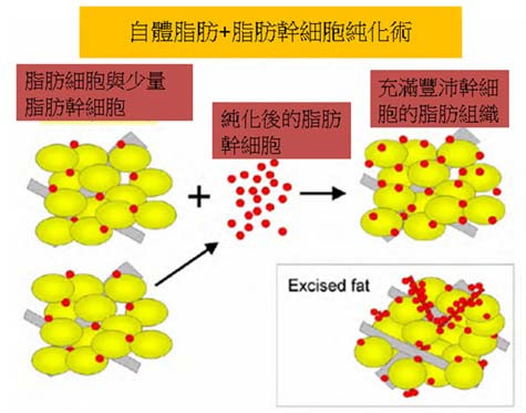 长春,自体脂肪,丰胸,效果,优势