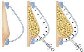 长春丰胸,注射丰胸