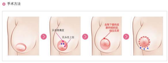乳房上提术,胸部下垂,恢复