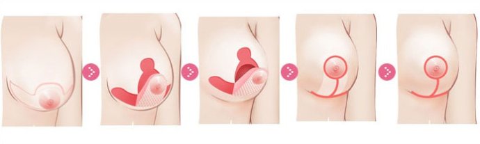 乳房下垂矫正,吉林铭医