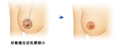 长春乳晕整形,长春乳晕缩小
