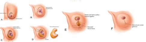 乳房缩小术,长春铭医,长春胸部整形