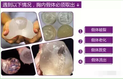 长春隆胸修复,隆胸修复价格,隆胸修复效果