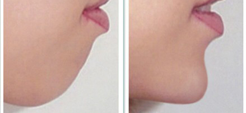 长春丰下巴,玻尿酸丰下巴