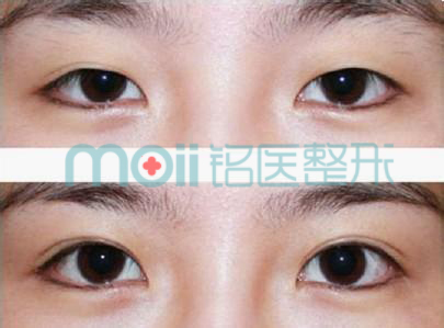 埋线双眼皮保持时间长不长？