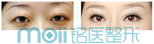 眼袋,对比图,长春好的整形医院