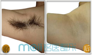 脱毛,5点冰点,对比图,长春好的整形医院