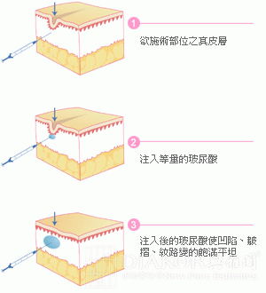长春玻尿酸,玻尿酸去皱