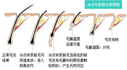 长春脱毛,脱毛哪里好,五度冰点脱毛