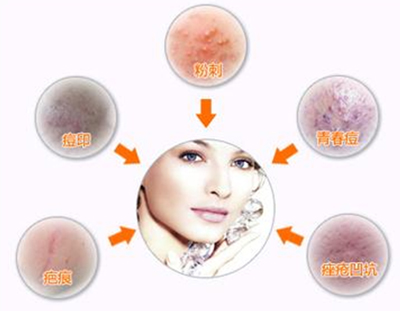 长春激光祛痘,祛痘多少钱