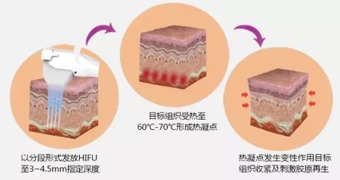 长春热拉提,长春黄金微针