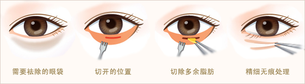 长春双眼皮,眼部综合整形,长春魅力电眼