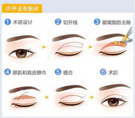 长春双眼皮,眼部综合整形,长春魅力电眼
