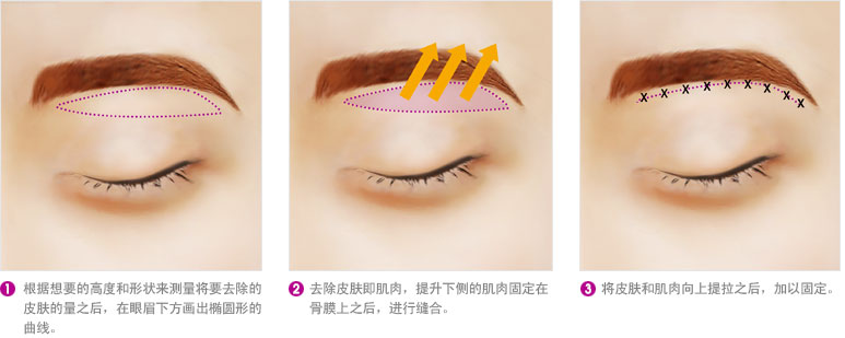 长春双眼皮,眼部综合整形,长春魅力电眼